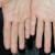 Hyperhidrosis