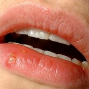 Profile picture for What Does Herpes Look Like
