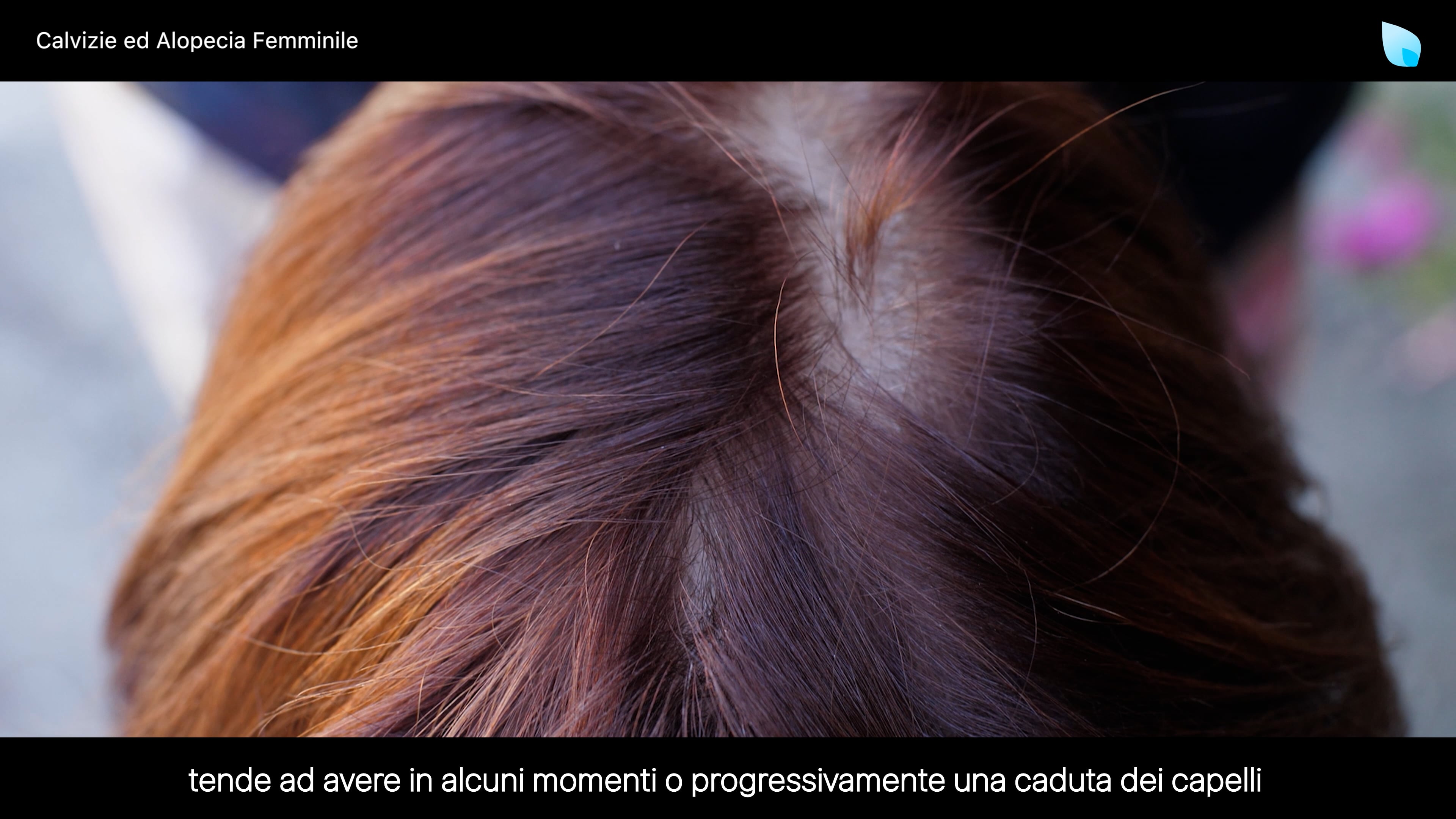 Calvizie Ed Alopecia Femminile On Vimeo