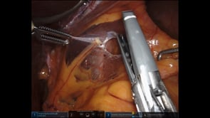 Massive Type 3 Paraoesophageal Hernia Repair with Mesh