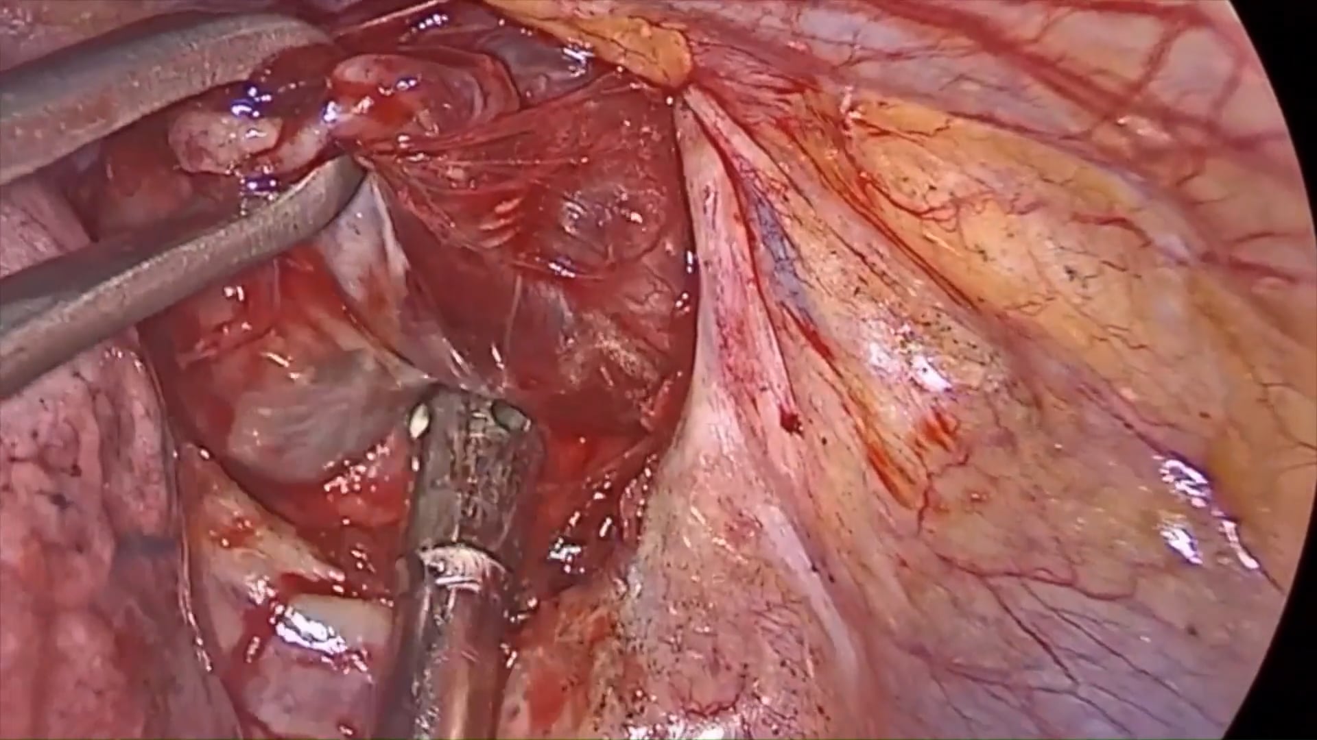 Transthoracic Resection Of Hyperplastic Parathyroid Gland Via A