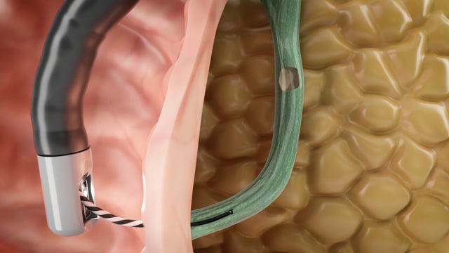 ERCP Aufkl&auml;rung