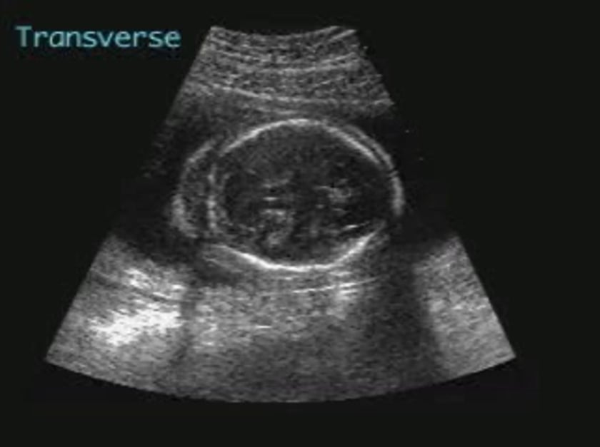 Nuchal Translucency Ultrasoundpaedia