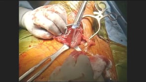 Laparoscopic Transhiatal Total Esophagectomy