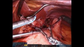 Robotic Gastric Bypass
