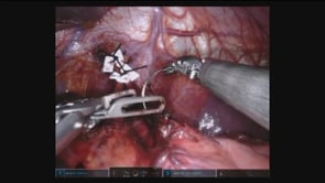 Robotic Heller Myotomy with Dor Fundoplication