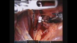 Robotic Hiatal Hernia Repair with Nissen Fundoplication