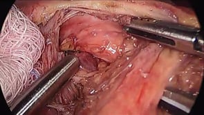 Laparoscopic Truncal & Selective Vagotomy