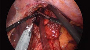 Laparoscopic Distal Esophagectomy