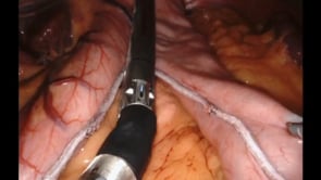 Robotic Sleeve Gastrectomy