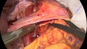 Laparoscopic Hiatal Hernia Repair with Toupet Fundoplication