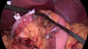 Laparoscopic Roux En Y Gastric Bypass – Retro Colic Transgastric GJ with a Stapled J-J Anastomosis