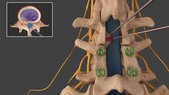 Medical - Spinal Surgery