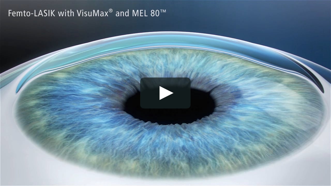 LASIK Laser Eye Surgery Animation on Vimeo