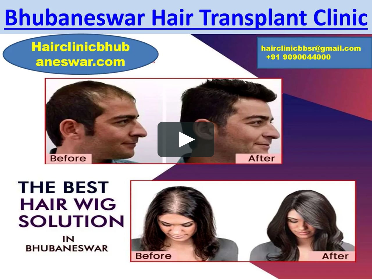 Hair transplant clinic in Bhubaneswar - Hair Doctor in Cuttack on Vimeo