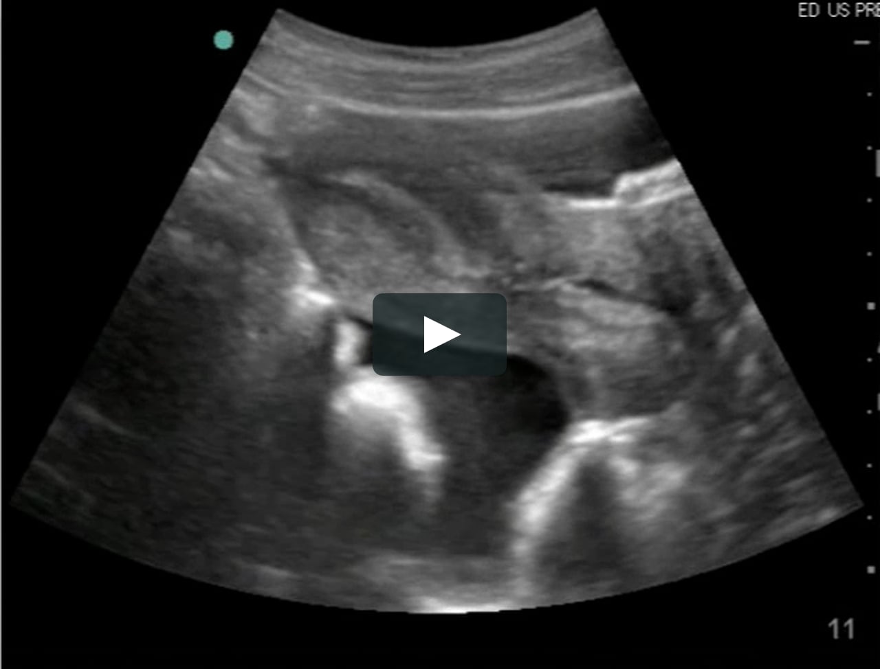 FAST Video 20 Moderate fluid in pouch of Douglas on Vimeo