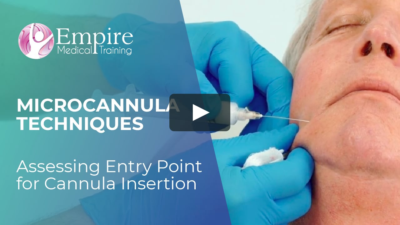 Assessing Entry Point for Cannula Insertion - MICROCANNULA TECHNIQUES ...