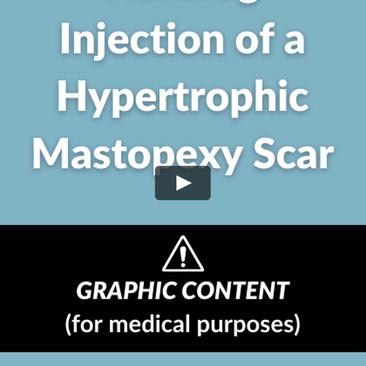 Kenalog Injection of a hypertrophic mastopexy scar on Vimeo