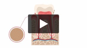 Dental Health and Periodontitis