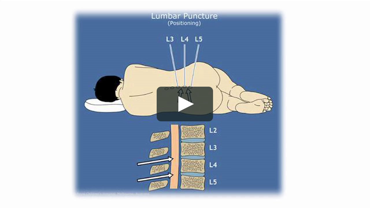 Understanding Lumbar Punctures on Vimeo