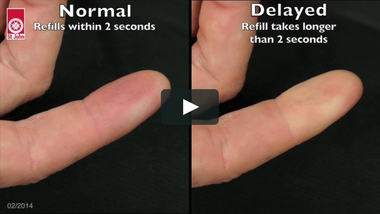 Skills Manual - Capillary Refill Time (Vidtip015) On Vimeo