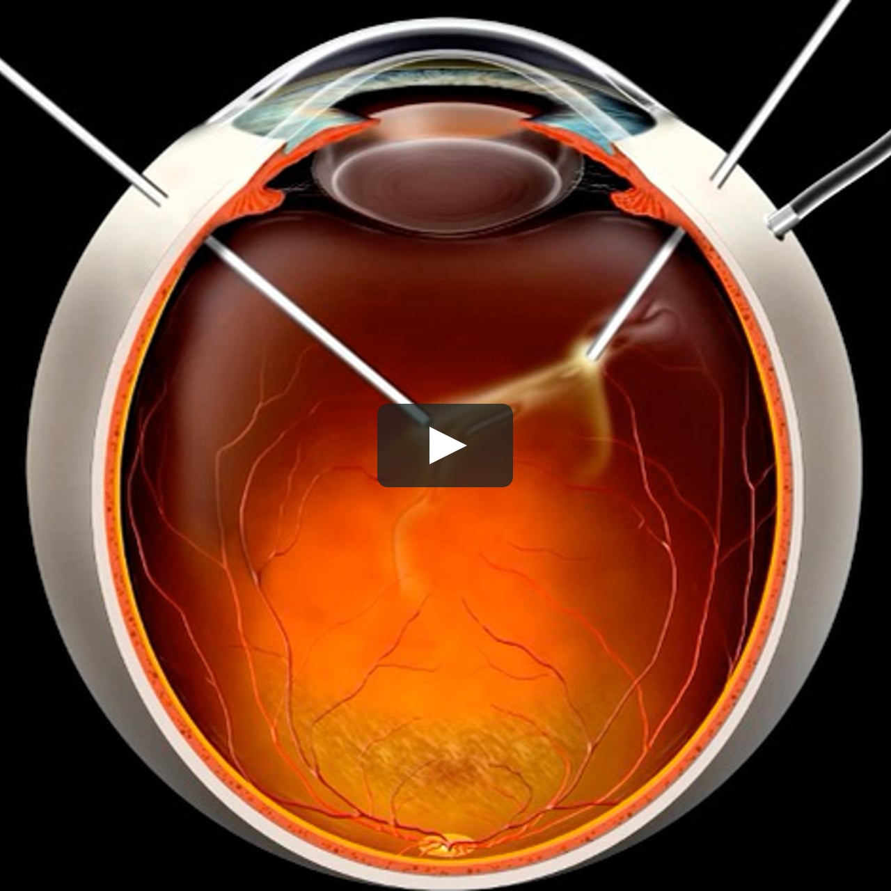 Пломбирование сетчатки. Отслойка сетчатки витрэктомия. Витрэктомия ретинопатия. Витрэктомия при диабетической ретинопатии. Отслойка сетчатки зрение глаза.