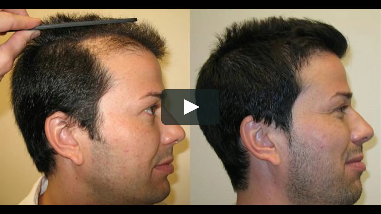 После голова три. Система волос для мужчин. Вырывание волос Эстетика на голове.