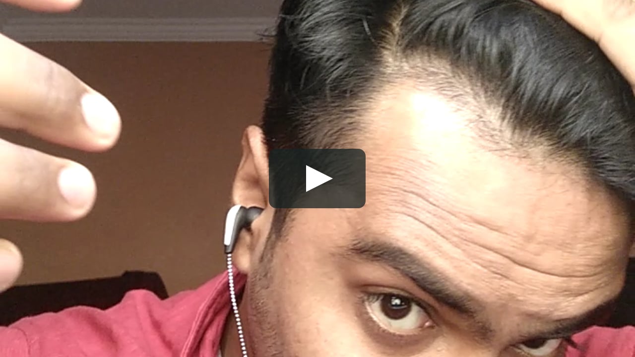 OMG ! Unbelievable Result of Balayam Yoga/Nail Rubbing - Hair Regrowth on  Vimeo