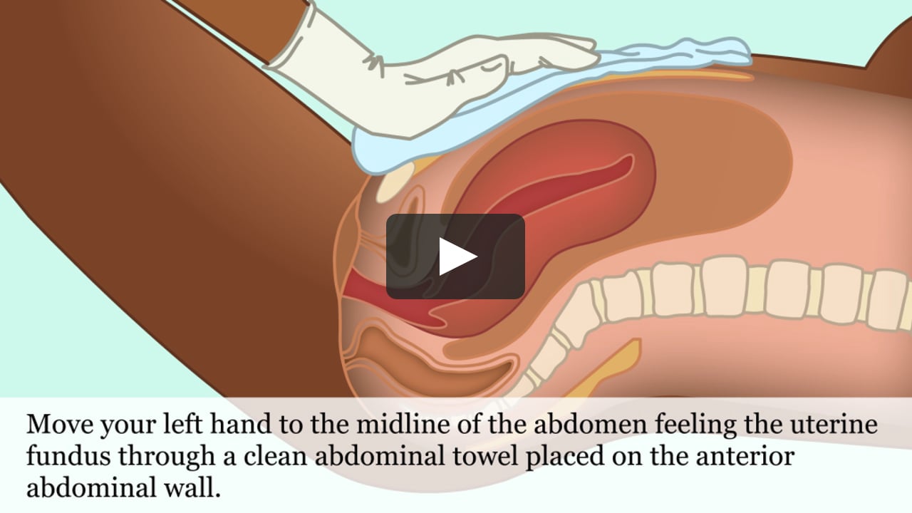 Postpartum IUD Insertion Animation Video (GLOWM) on Vimeo