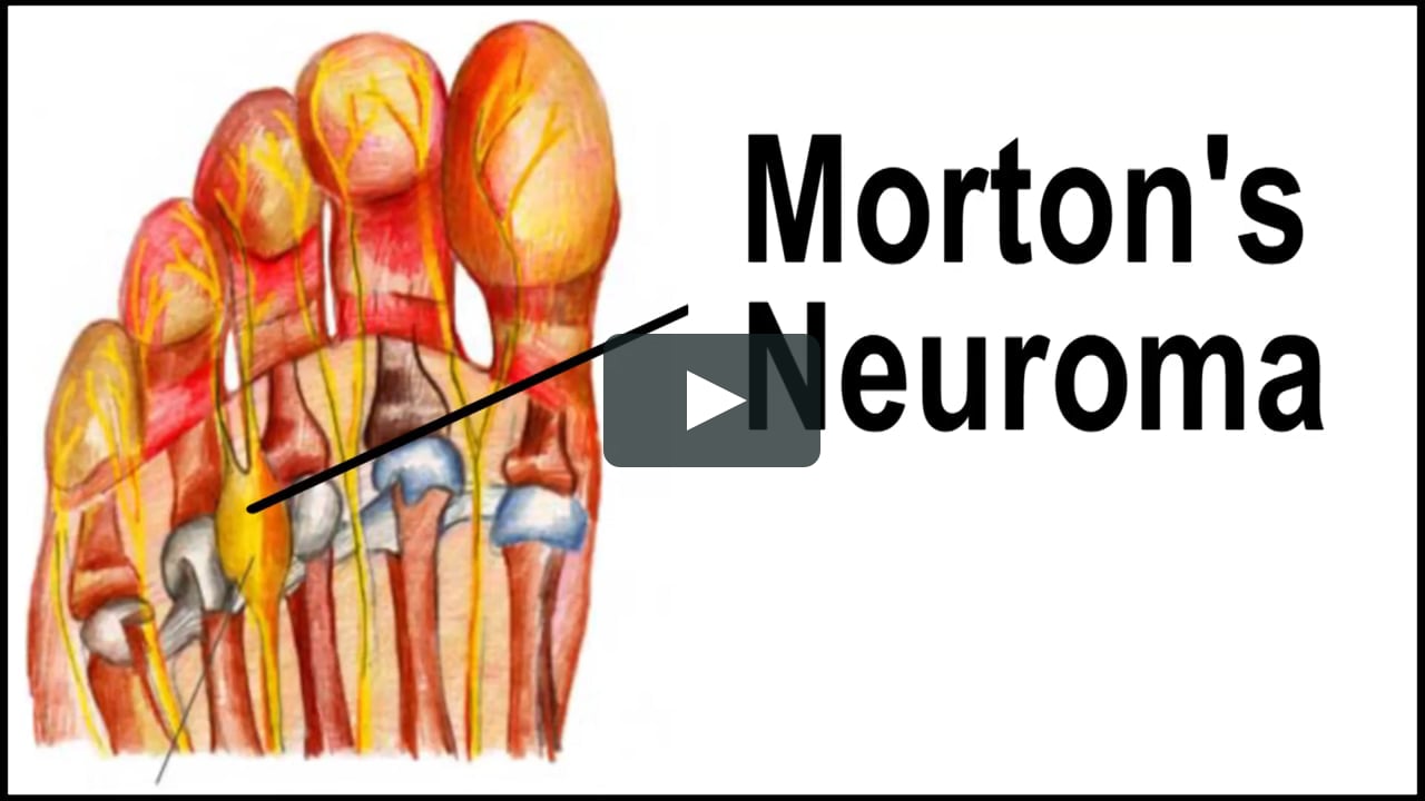 Cuanto cuesta una operación de neuroma de morton