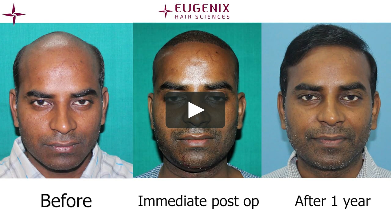 Difficult Hair Transplant in Grade 7; 6052 grafts in Eugenix by Dr Pradeep  Sethi and Arika Bansal on Vimeo