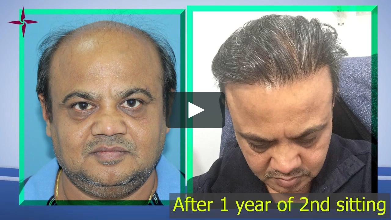 6244 DHT-FUE grafts hair transplant in grade 7 by Drs Sethi-Bansal, Eugenix  on Vimeo