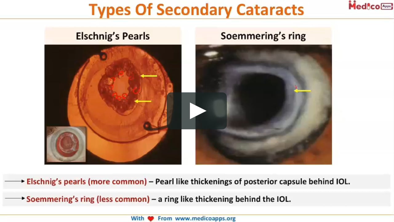 proza Elasticiteit Onrustig Complications of cataract surgery on Vimeo
