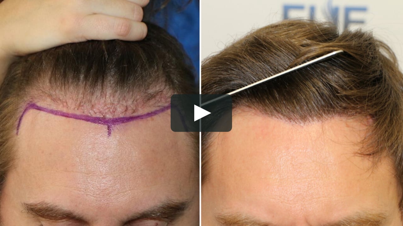 1600 Grafts FUE Hair Transplant by Dr. Juan Couto - FUEXPERT CLINIC on Vimeo