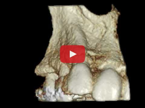 Osteoma Mandibular