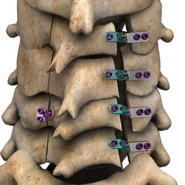 Stryker Spine