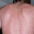 Yeast Infection Home Remedy