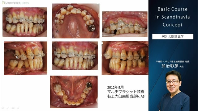 #4 病的歯牙移動