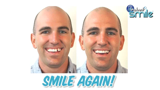 instantsmile Instant Smile MULTISHADE Patented Temporary Tooth