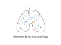 Sanofi Genzyme · Inflamación de de tipo 2 en asma grave · WhiteBoard