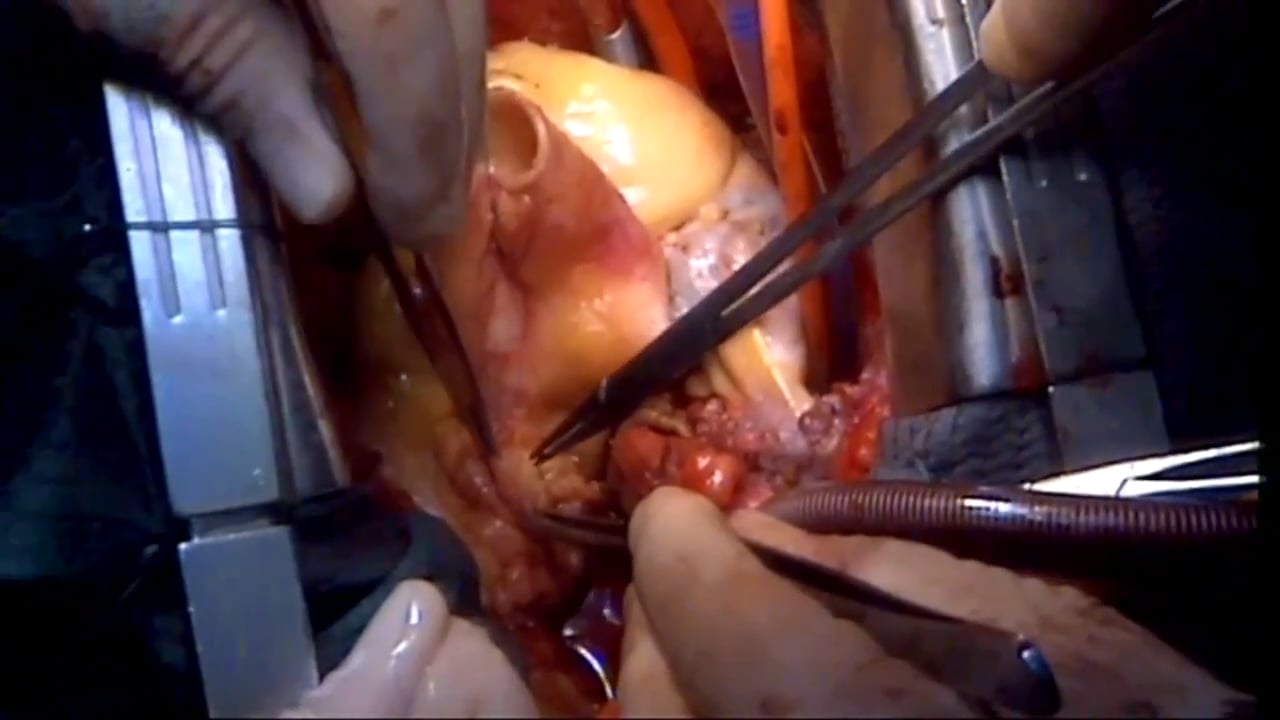 open heart surgery video