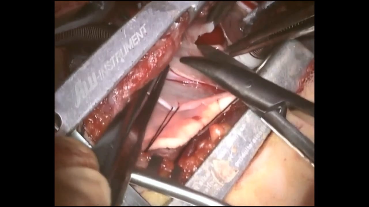 Non-visible scar surgery: Right axillary thoracotomy approach for ...