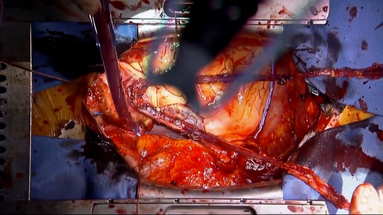 Piggyback anastomosis using a single Heartstring device: A low ...