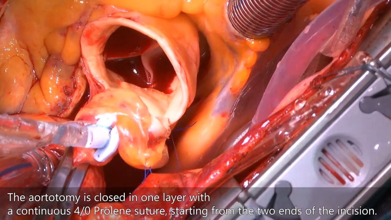 cardiac valve replacement