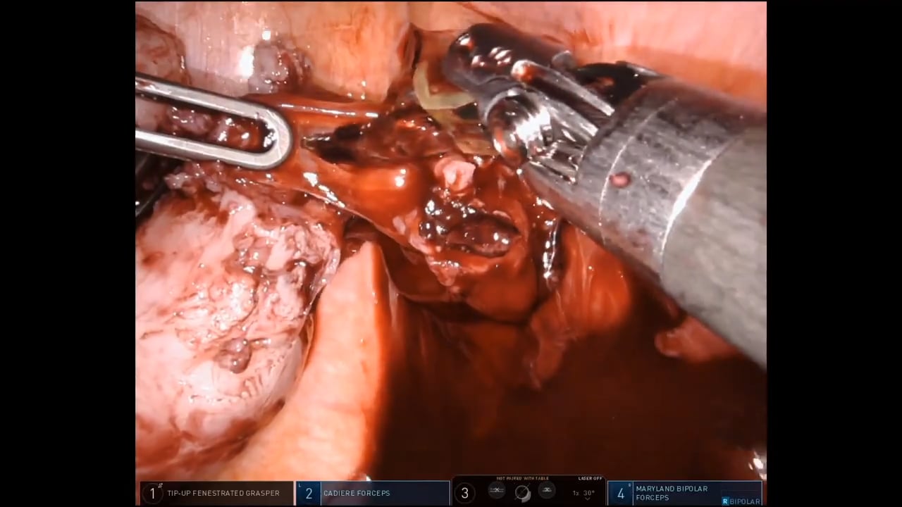 Pure Robotic Transversectomy/Transverse Colectomy for Moderately Advanced Colon Cancer