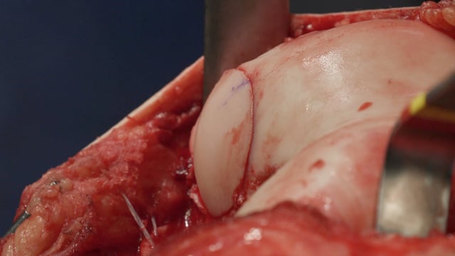 Lateral OCA and Meniscus Allograft Transplantation