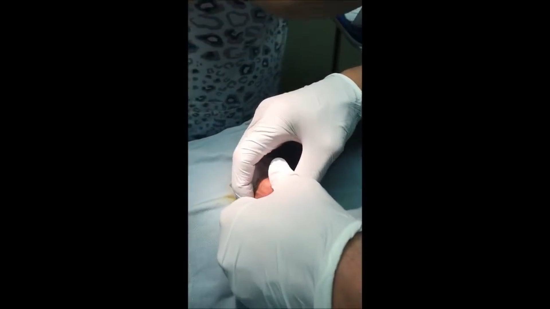 Older Child Circumcision at Pollock Clinics