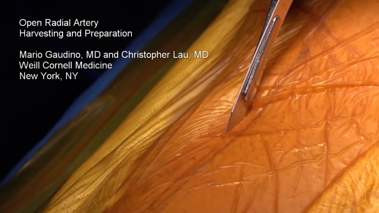 Treatment outcomes of the loop and open-close clip closure method