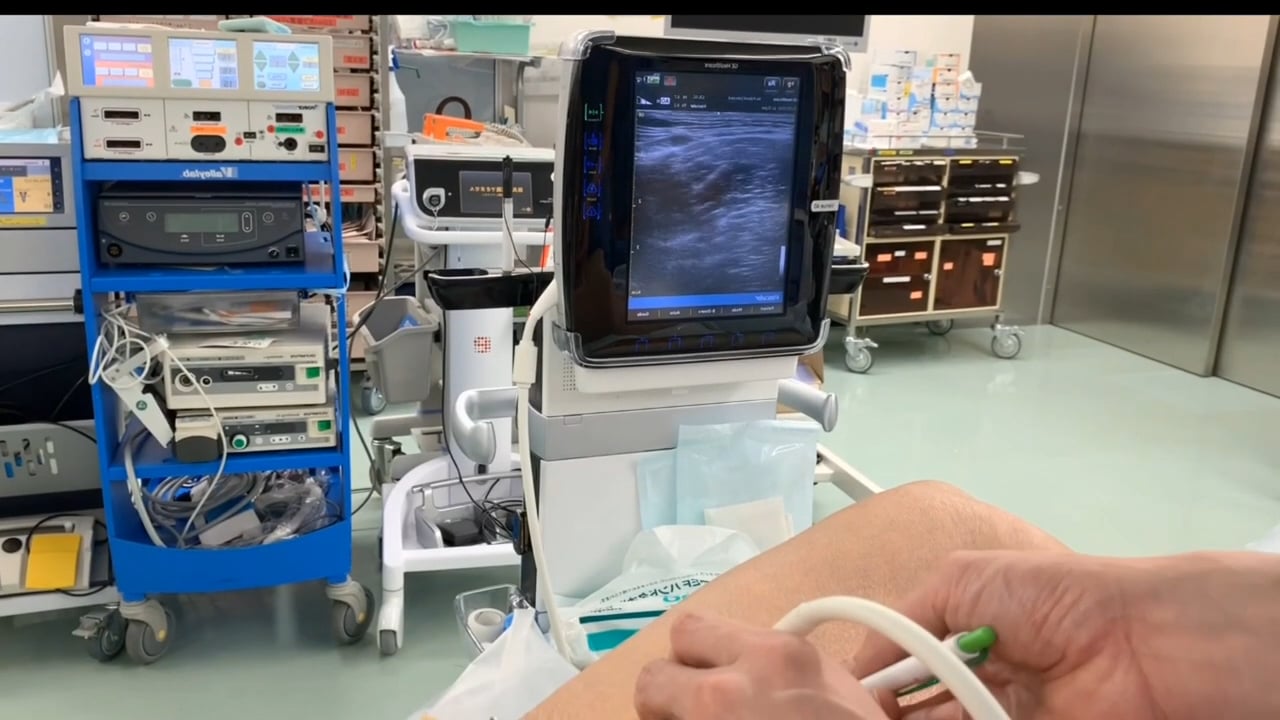The endoscopic notouch saphenous vein harvesting technique MMCTS