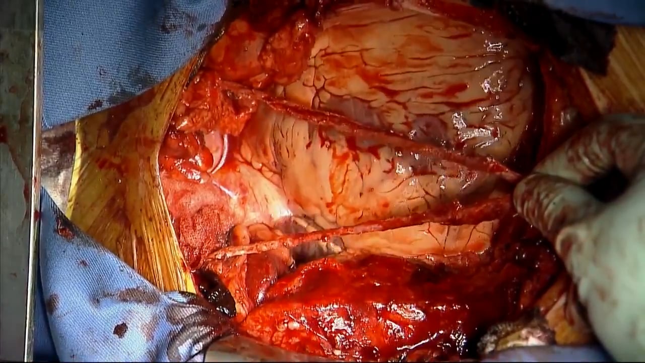 A simple and safe removal method for the HEARTSTRING III Proximal Seal ...